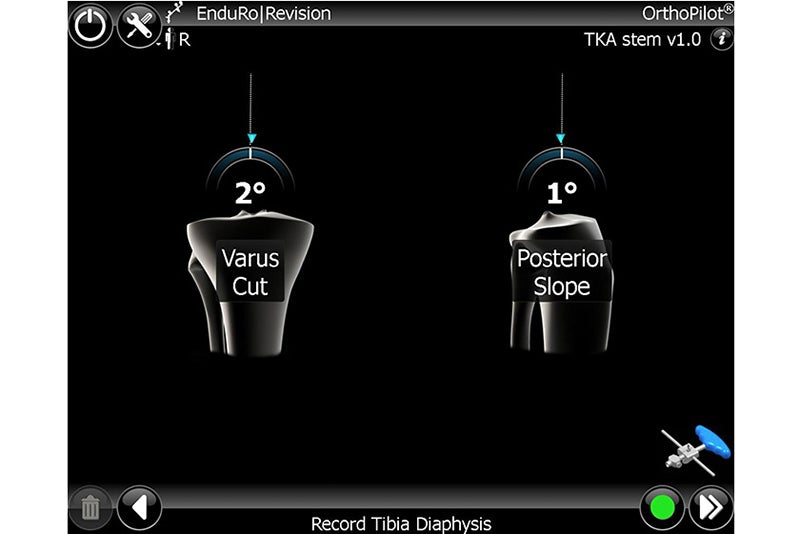 Record Tibia Diaphysis