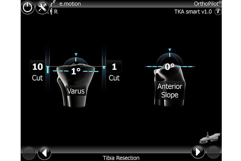 Tibia Resection