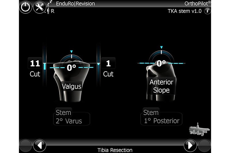Tibia Resection