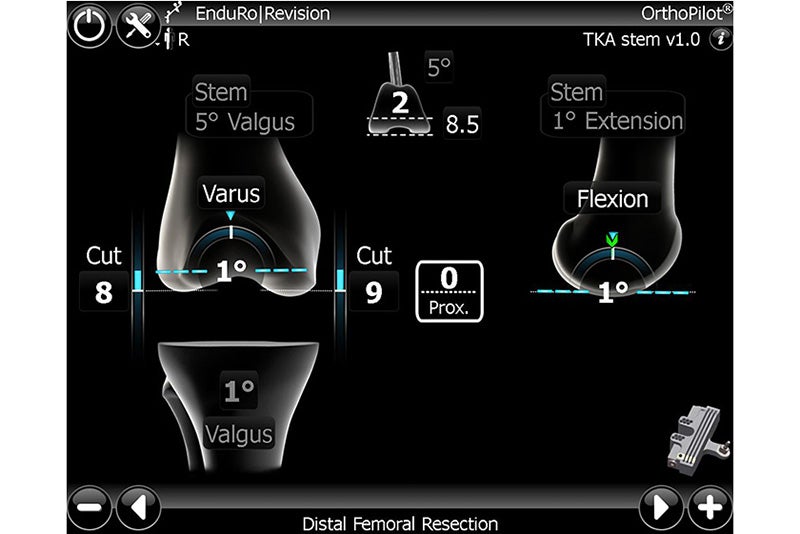 Distal Femoral Resection