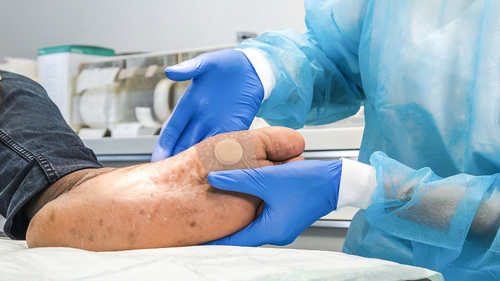 To hænder med handsker holder en diabetisk fod med et plaster på, i baggrunden medicinsk materiale i et lægerum